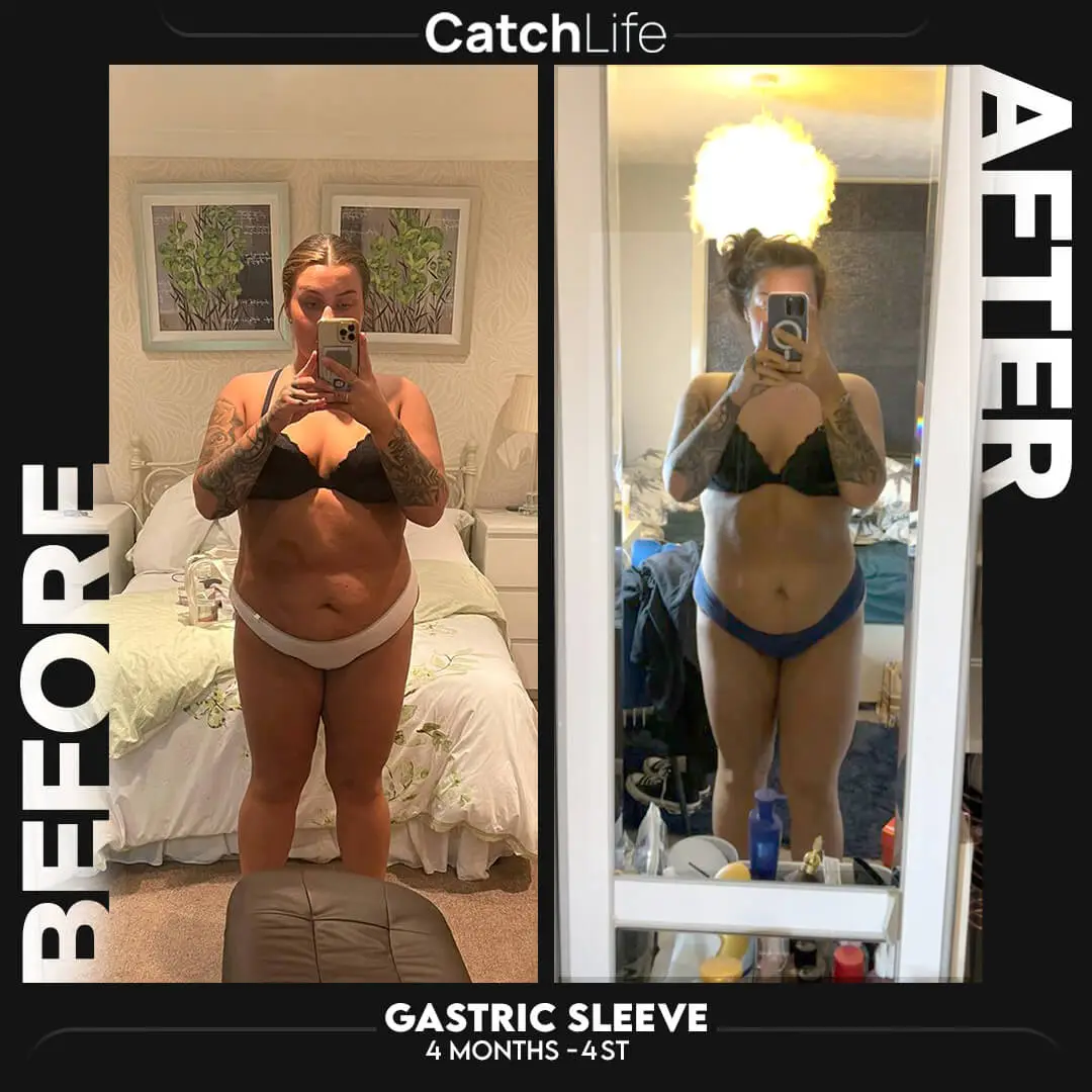 gastric sleeve before after image