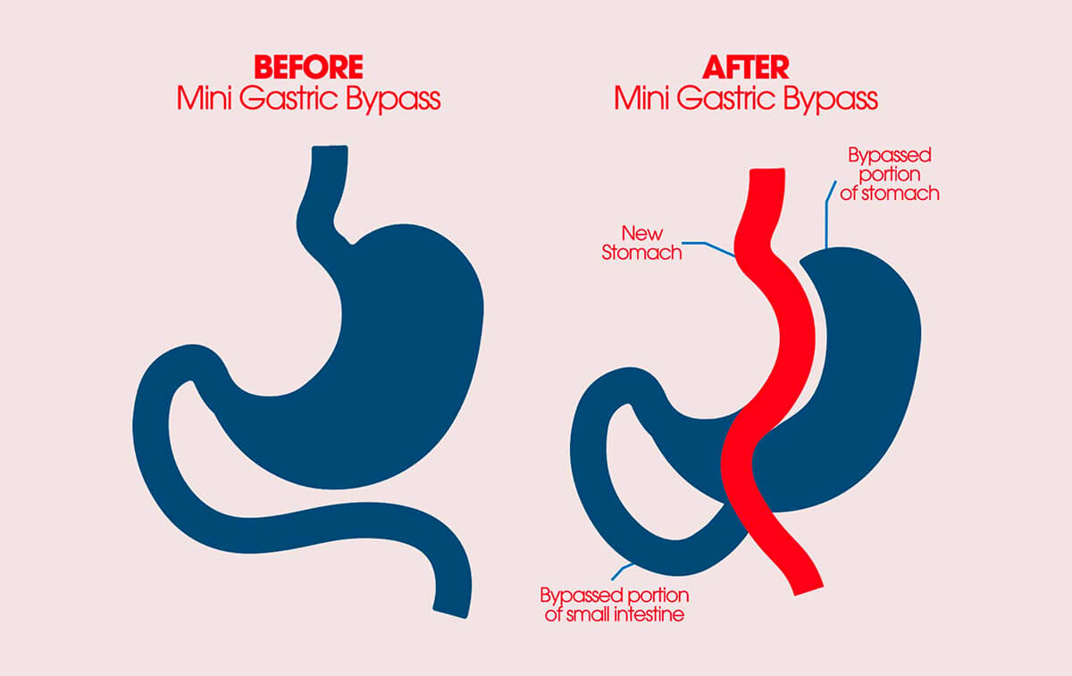 gastric bypass img4