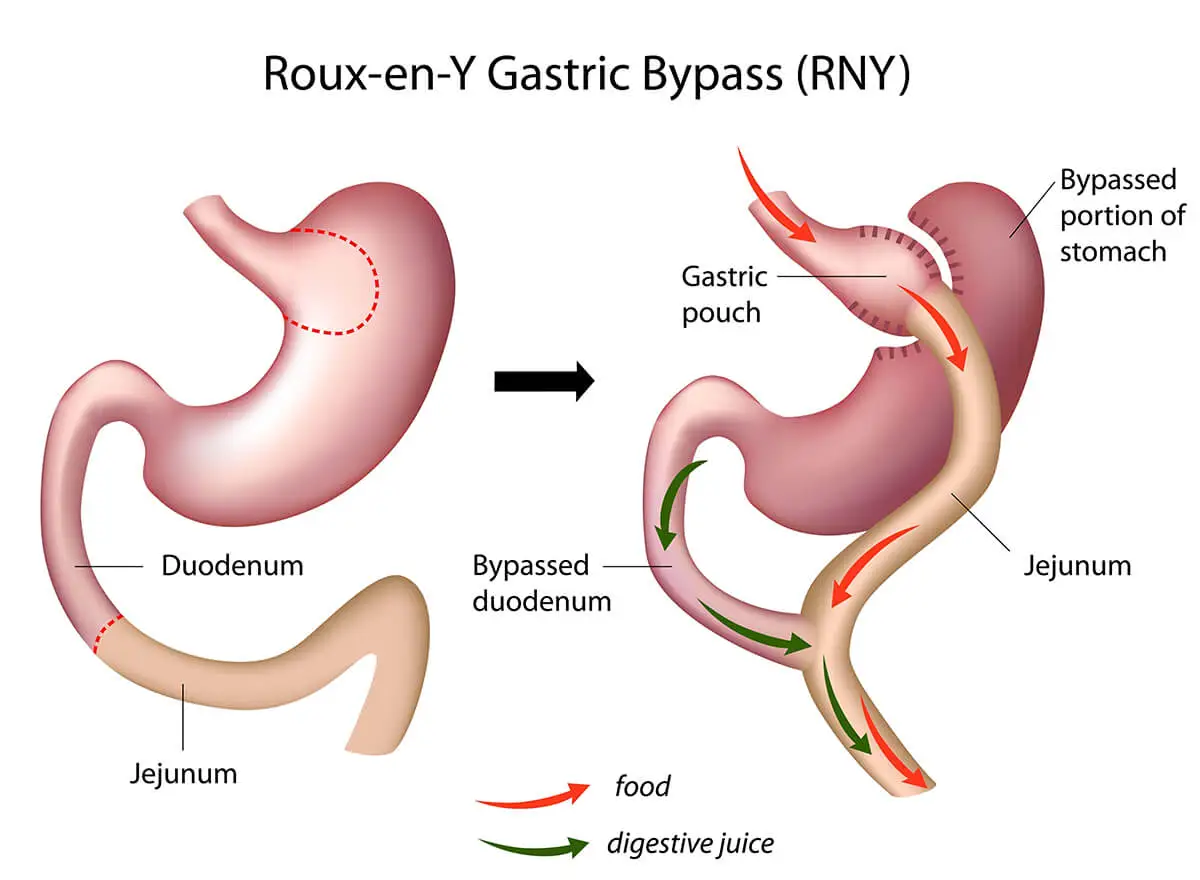 roux en y gastric bypass graphic