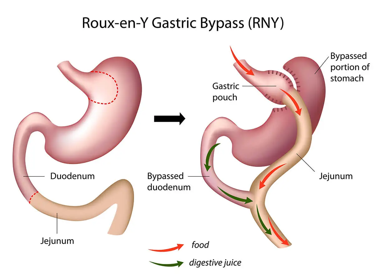 roux en y gastric bypass Grafik