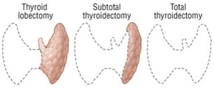 thyroid figure 3