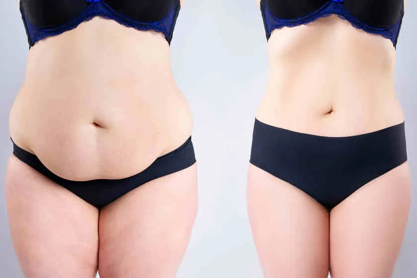 Tips To Minimize Sagging Skin After Gastric Bypass