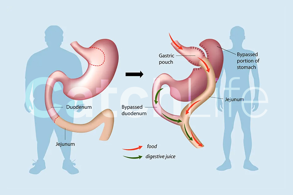 Does Gastric Bypass Offer Permanent Solution to Obesity?