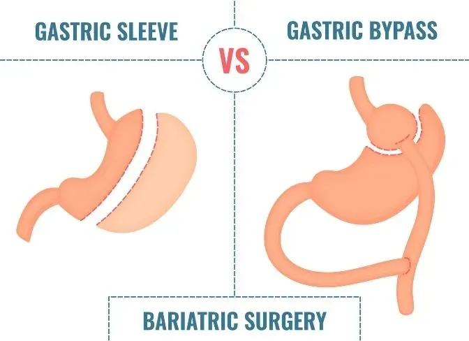 Gastric Sleeve vs Gastric Bypass: Which One is Right for You?